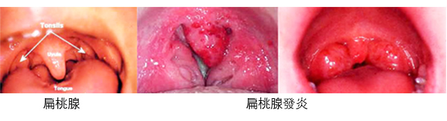 扁桃腺炎 亞洲大學附屬醫院